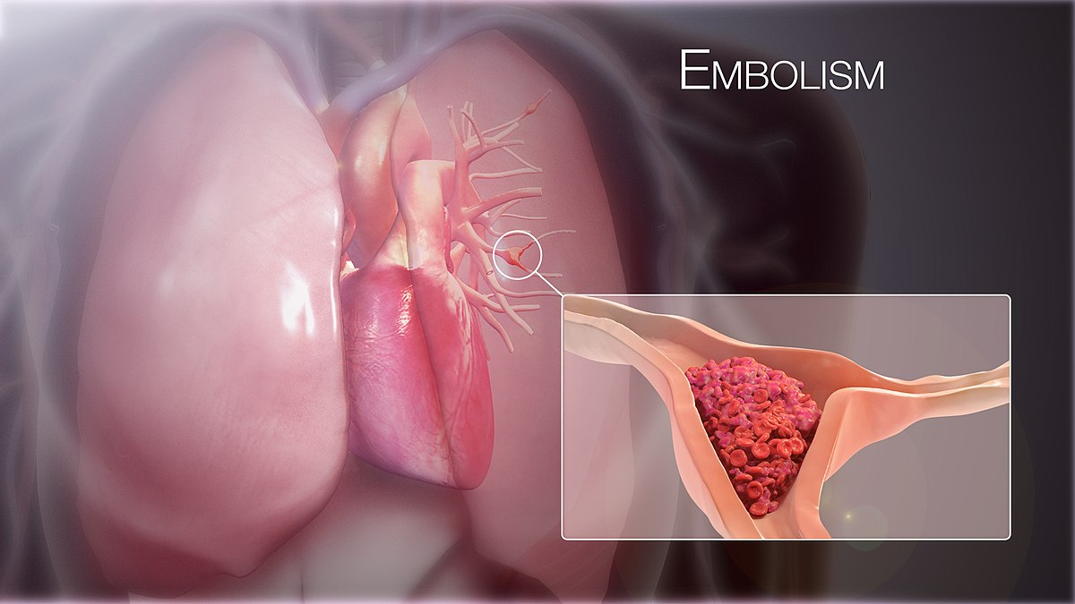 Un émbolo o trombo produce una embolia o embolismo pulmorar